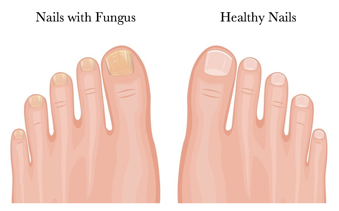 Extra Strength Toenail Fungus Treatment - Made In USA, Nail Fungus Solution  for Toe Nail & Fingernails - Fix Thick, broken & Fungal Discolored Nails-  Renew Fungi Damaged Nail, & Cracked Nails